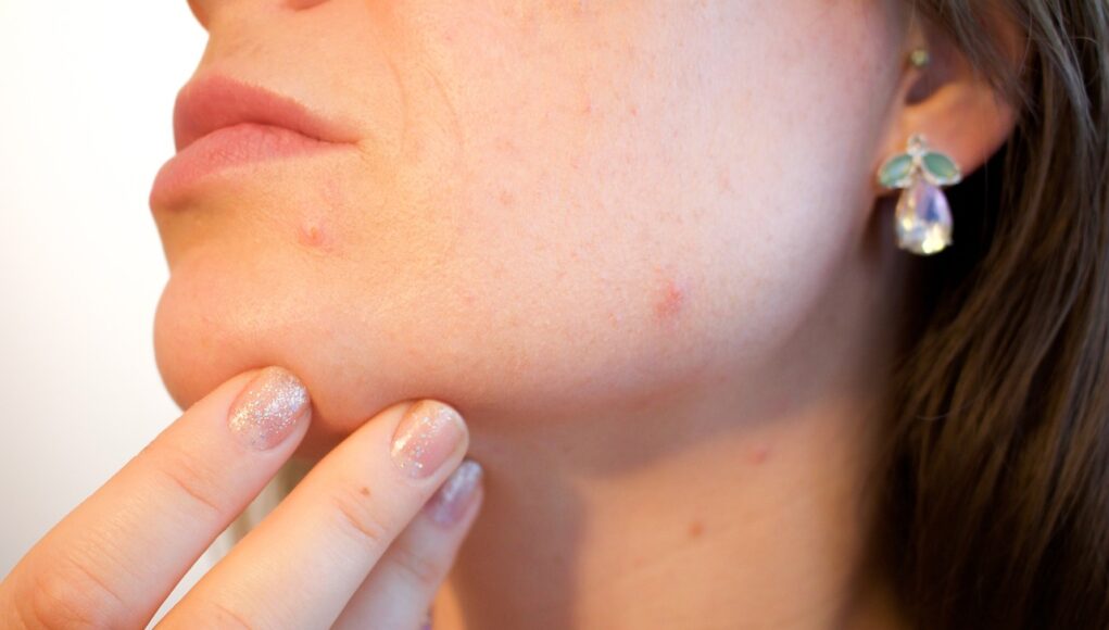 pimple